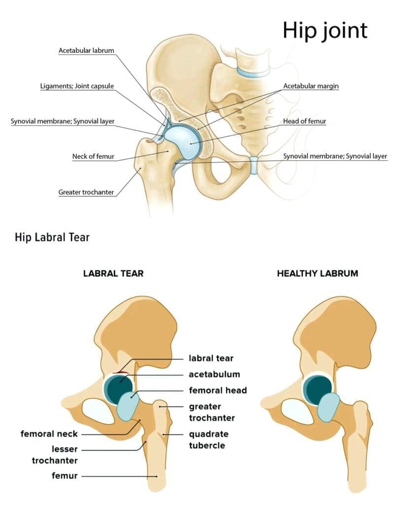 Hip Injuries After Car Accidents