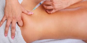 Platelet-Rich Plasma (PRP) Therapy for Sciatica